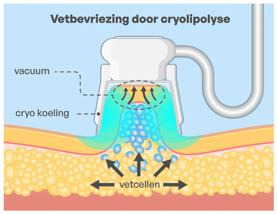 cryolipolyse